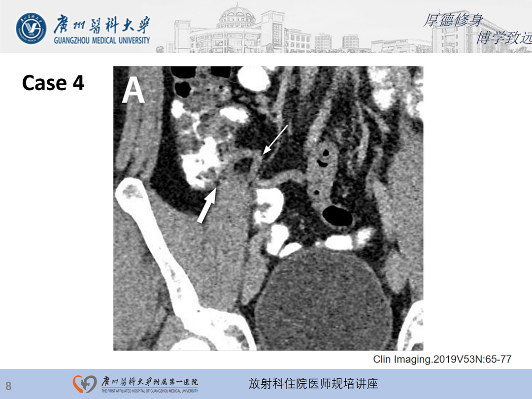 影像PPT - 【PPT】急性阑尾炎影像诊断思考和综述-9