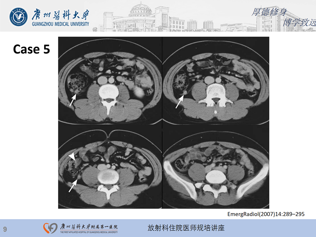 影像PPT - 【PPT】急性阑尾炎影像诊断思考和综述-10