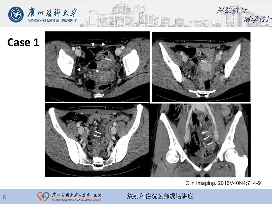影像PPT - 【PPT】急性阑尾炎影像诊断思考和综述-6