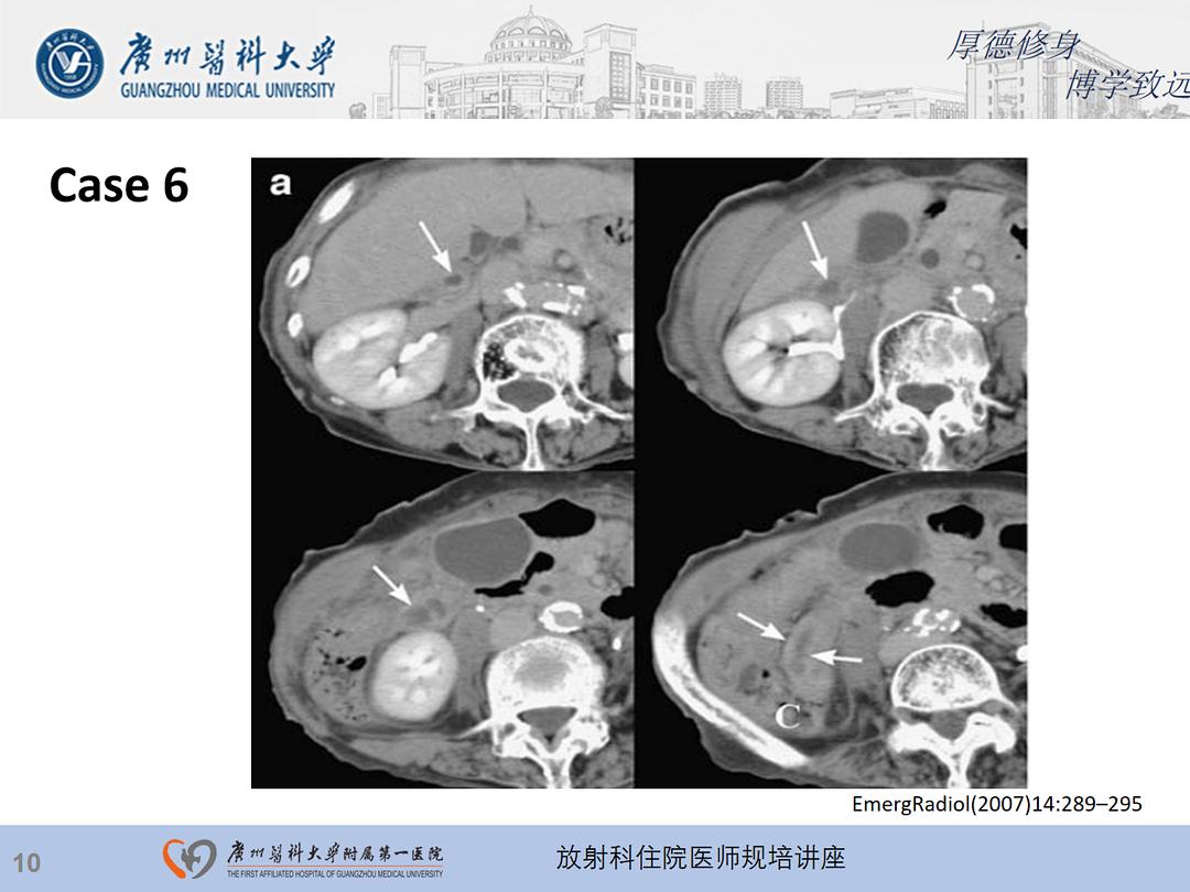 影像PPT - 【PPT】急性阑尾炎影像诊断思考和综述-11