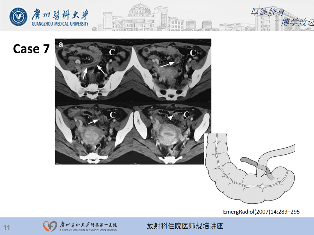 影像PPT - 【PPT】急性阑尾炎影像诊断思考和综述-12