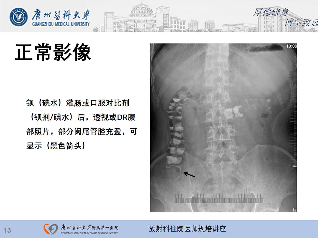影像PPT - 【PPT】急性阑尾炎影像诊断思考和综述-14