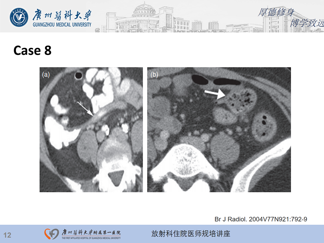 影像PPT - 【PPT】急性阑尾炎影像诊断思考和综述-13