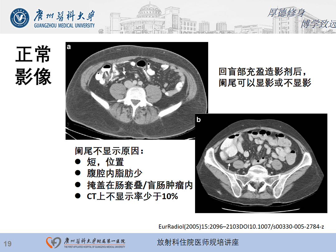 影像PPT - 【PPT】急性阑尾炎影像诊断思考和综述-20