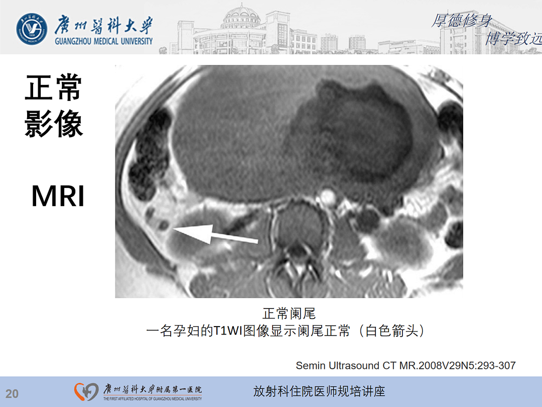 影像PPT - 【PPT】急性阑尾炎影像诊断思考和综述-21