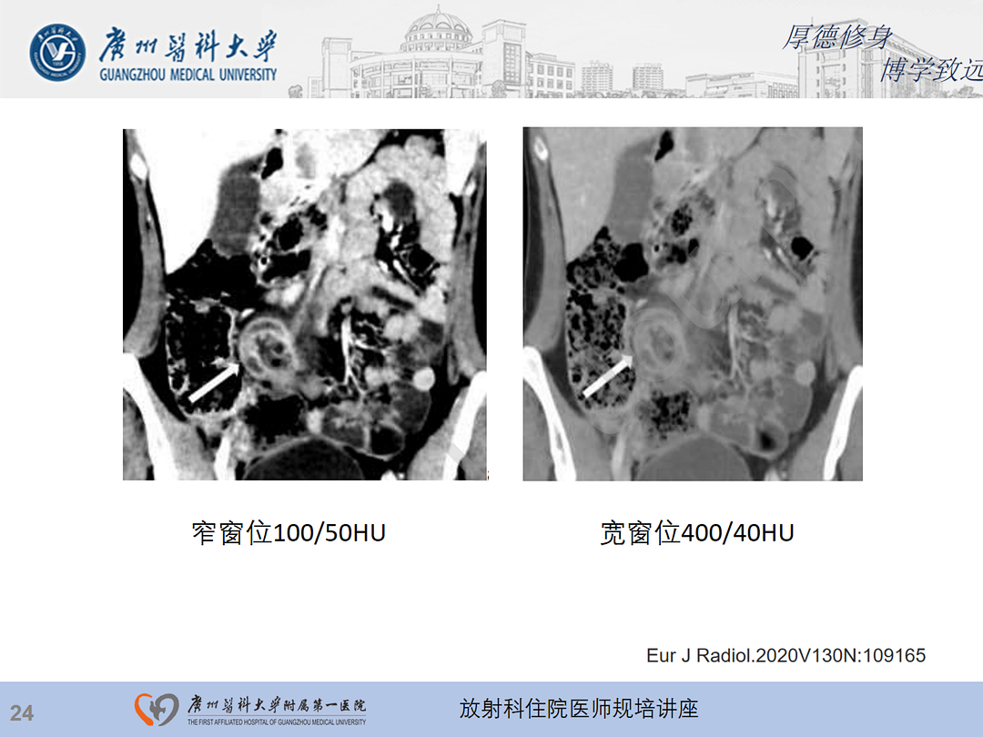 影像PPT - 【PPT】急性阑尾炎影像诊断思考和综述-25