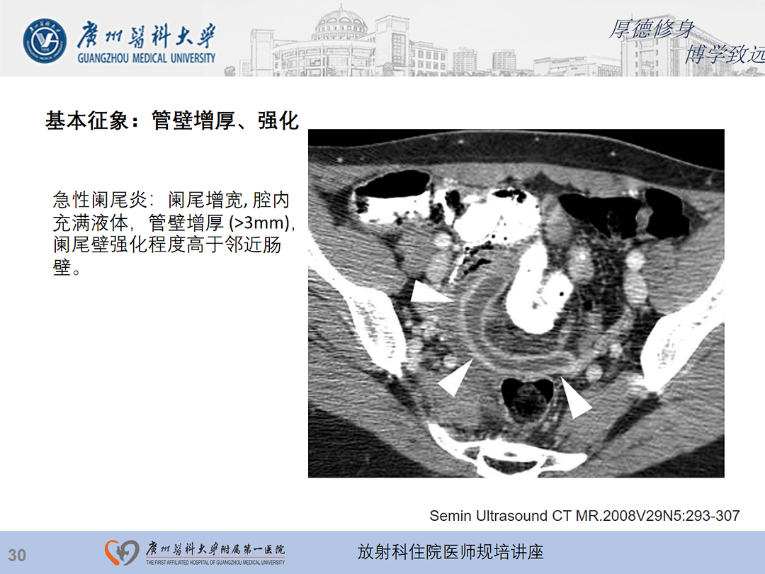 影像PPT - 【PPT】急性阑尾炎影像诊断思考和综述-31