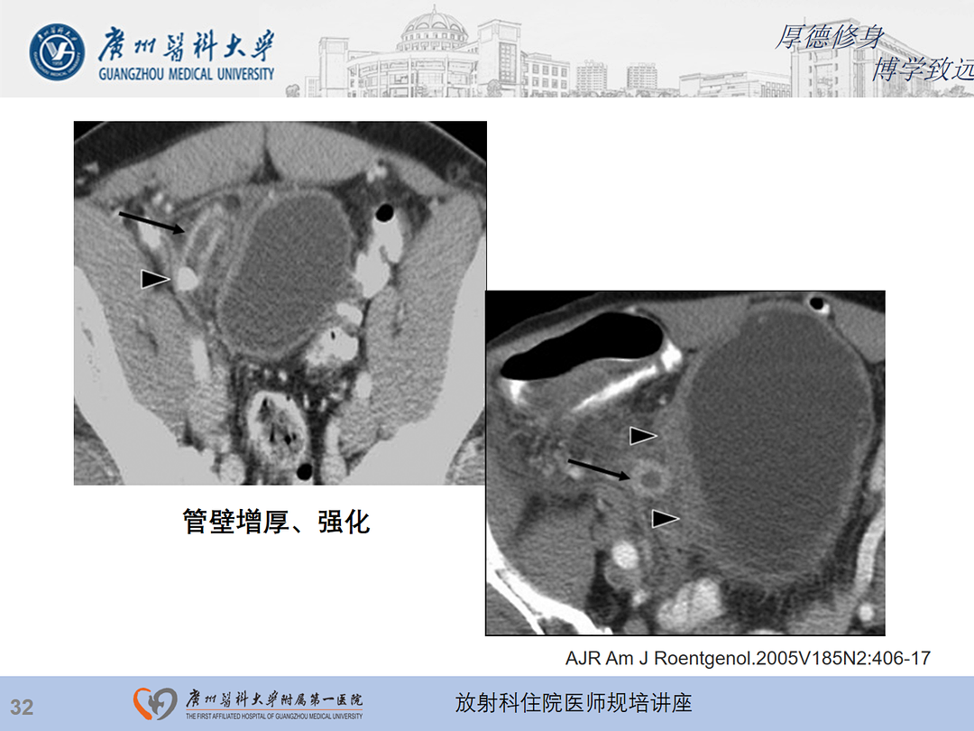 影像PPT - 【PPT】急性阑尾炎影像诊断思考和综述-33