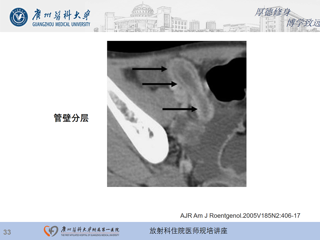 影像PPT - 【PPT】急性阑尾炎影像诊断思考和综述-34
