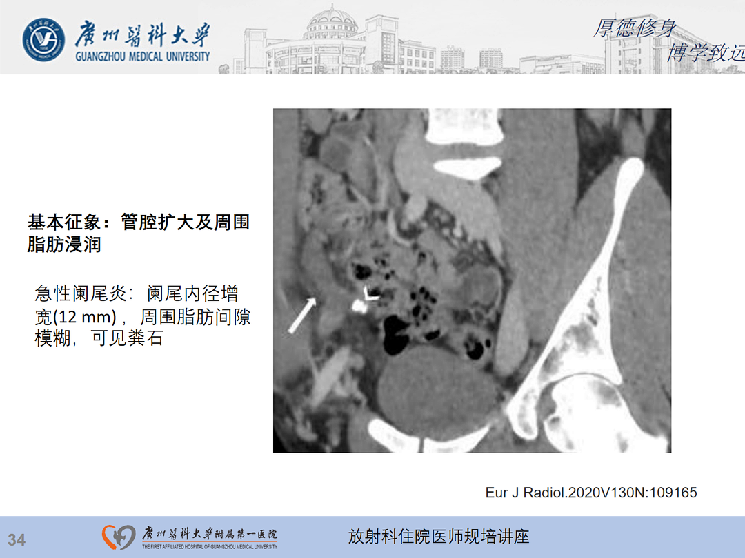 影像PPT - 【PPT】急性阑尾炎影像诊断思考和综述-35