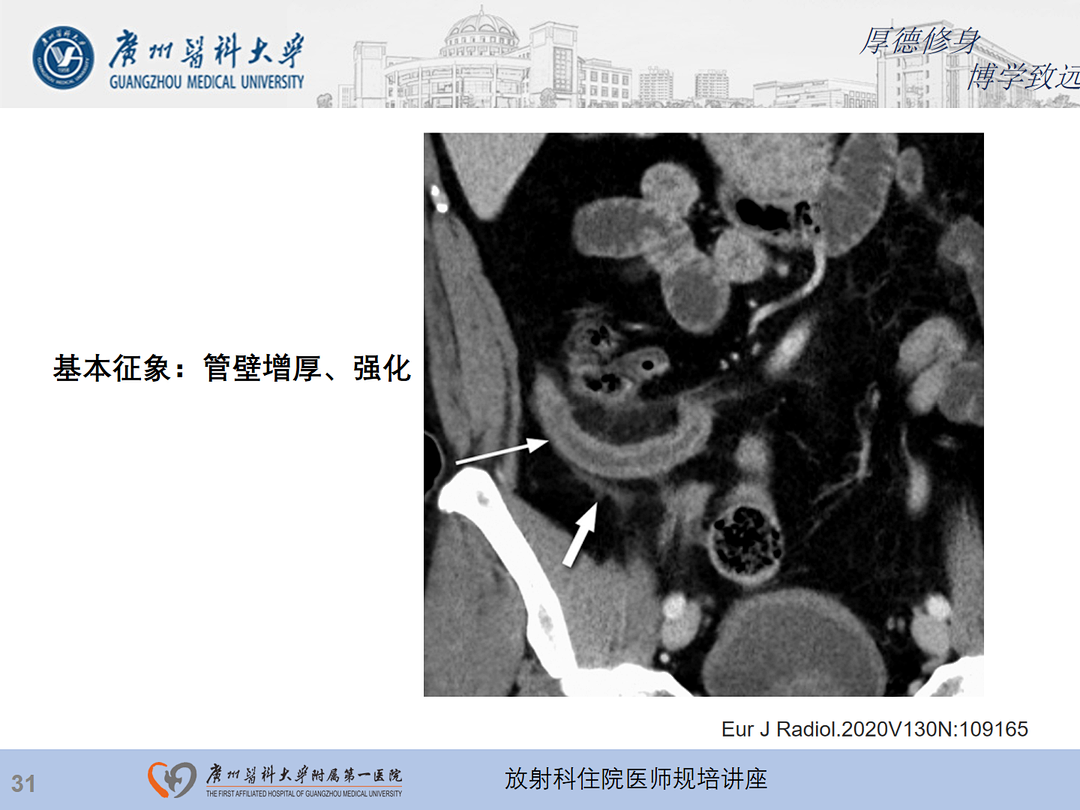 影像PPT - 【PPT】急性阑尾炎影像诊断思考和综述-32
