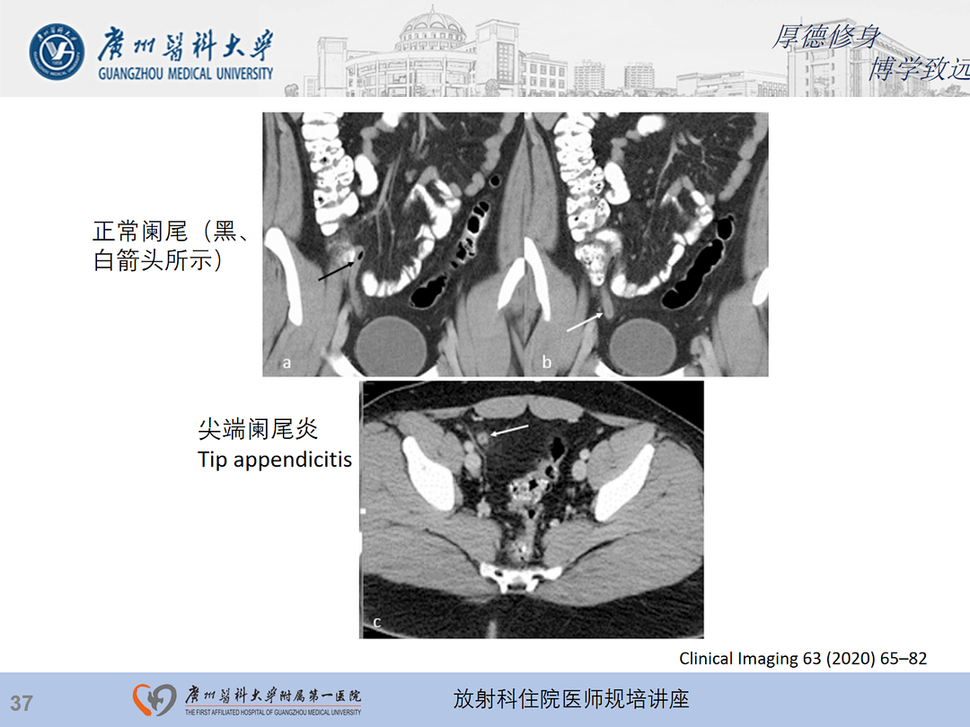 影像PPT - 【PPT】急性阑尾炎影像诊断思考和综述-38