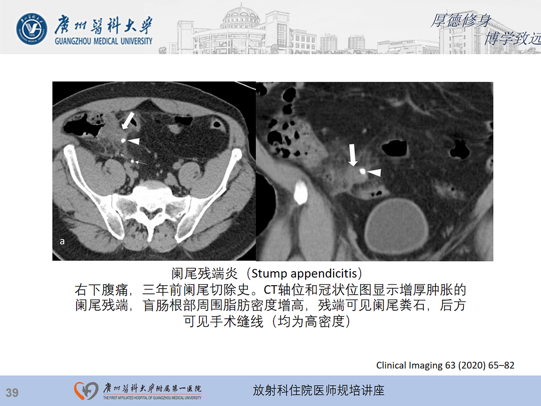 影像PPT - 【PPT】急性阑尾炎影像诊断思考和综述-40