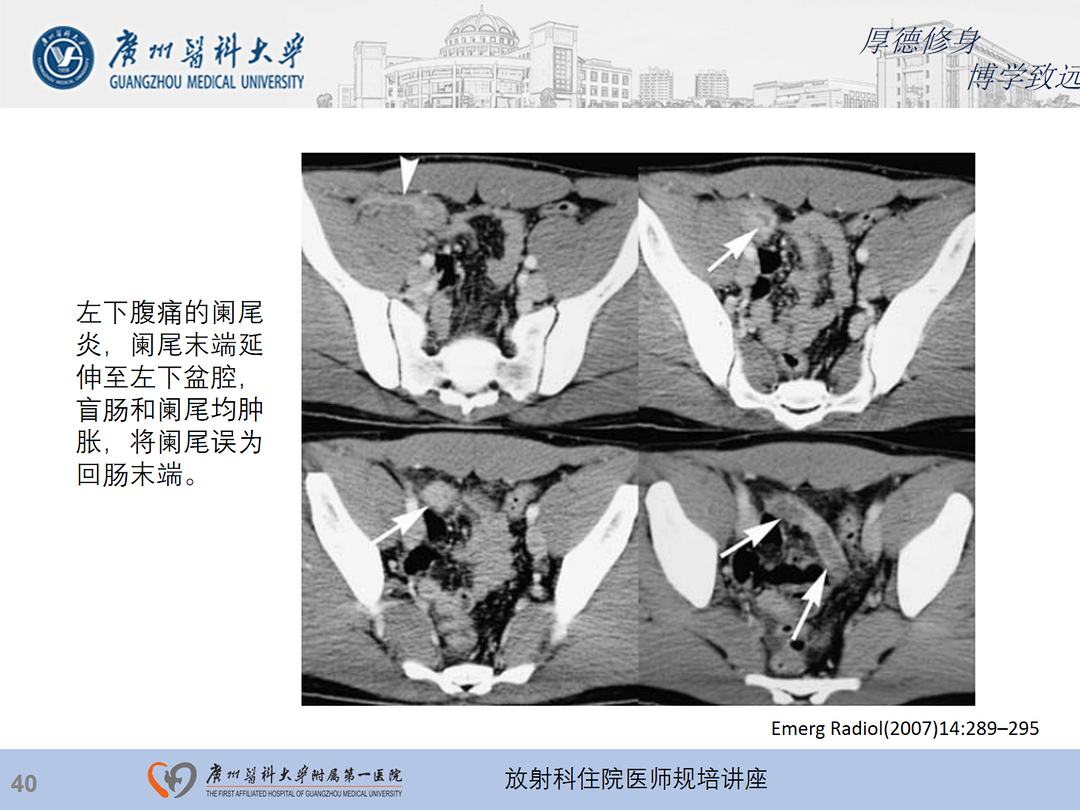 影像PPT - 【PPT】急性阑尾炎影像诊断思考和综述-41