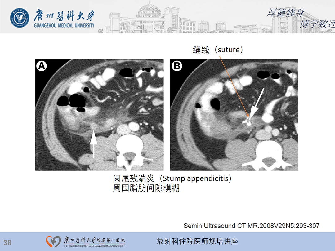 影像PPT - 【PPT】急性阑尾炎影像诊断思考和综述-39