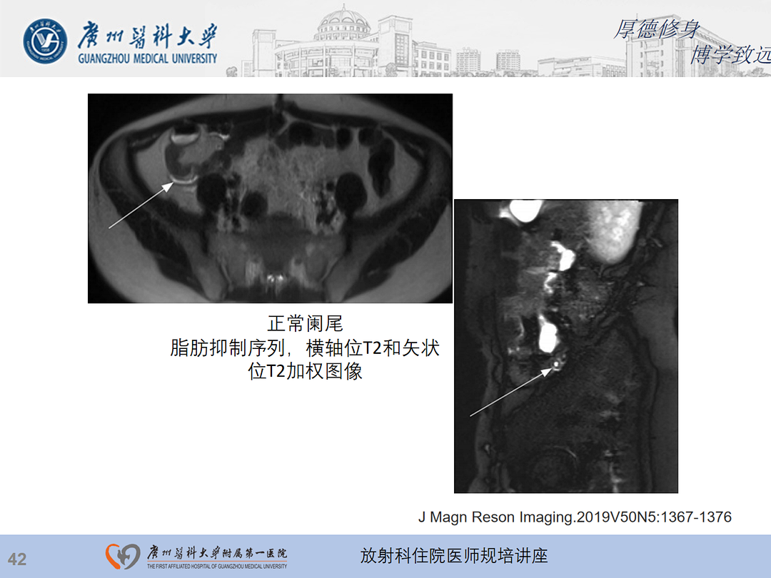 影像PPT - 【PPT】急性阑尾炎影像诊断思考和综述-43
