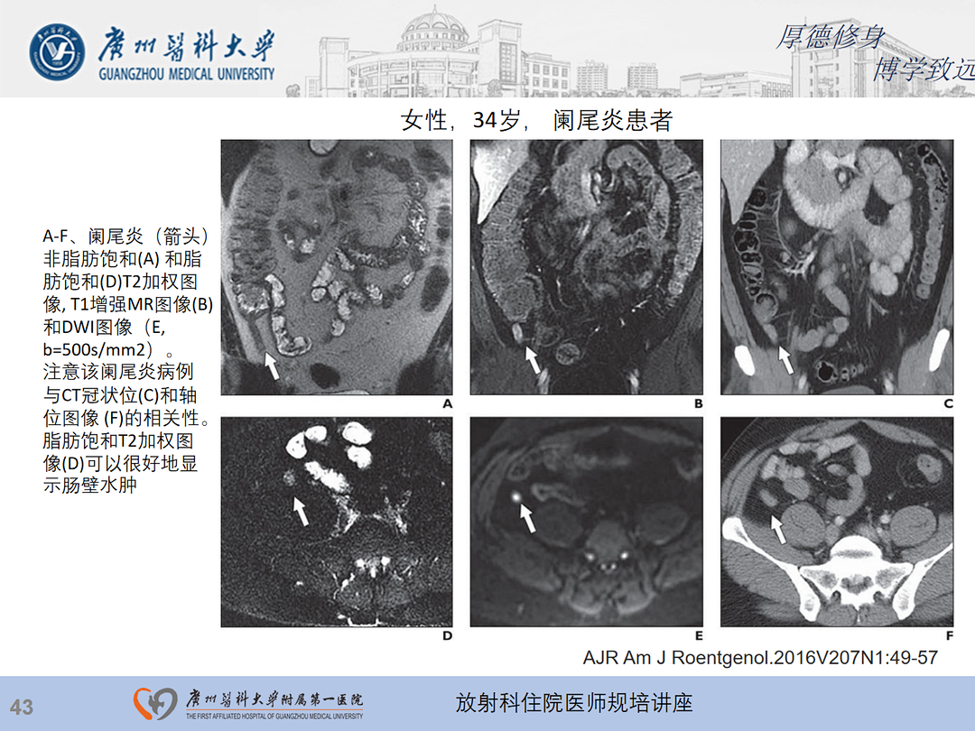 影像PPT - 【PPT】急性阑尾炎影像诊断思考和综述-44