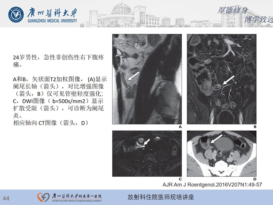 影像PPT - 【PPT】急性阑尾炎影像诊断思考和综述-45