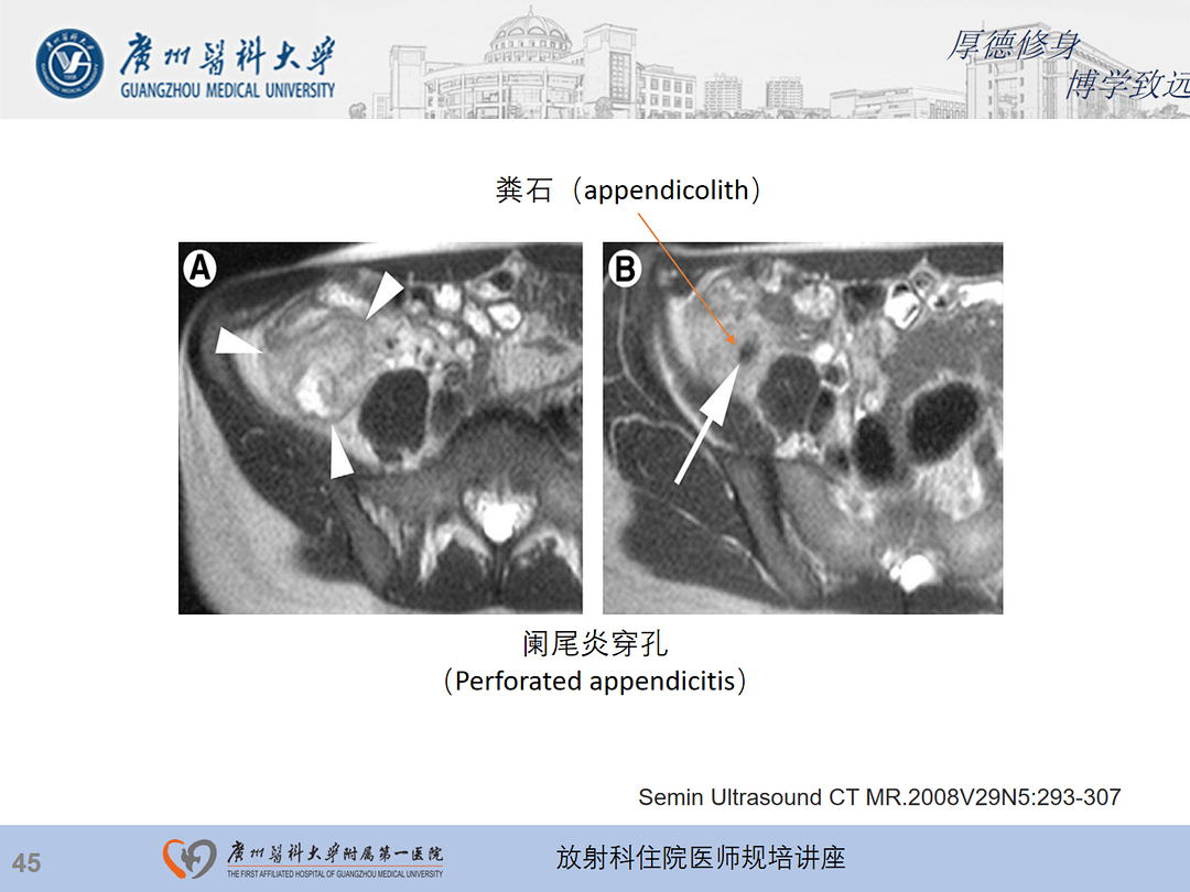 影像PPT - 【PPT】急性阑尾炎影像诊断思考和综述-46