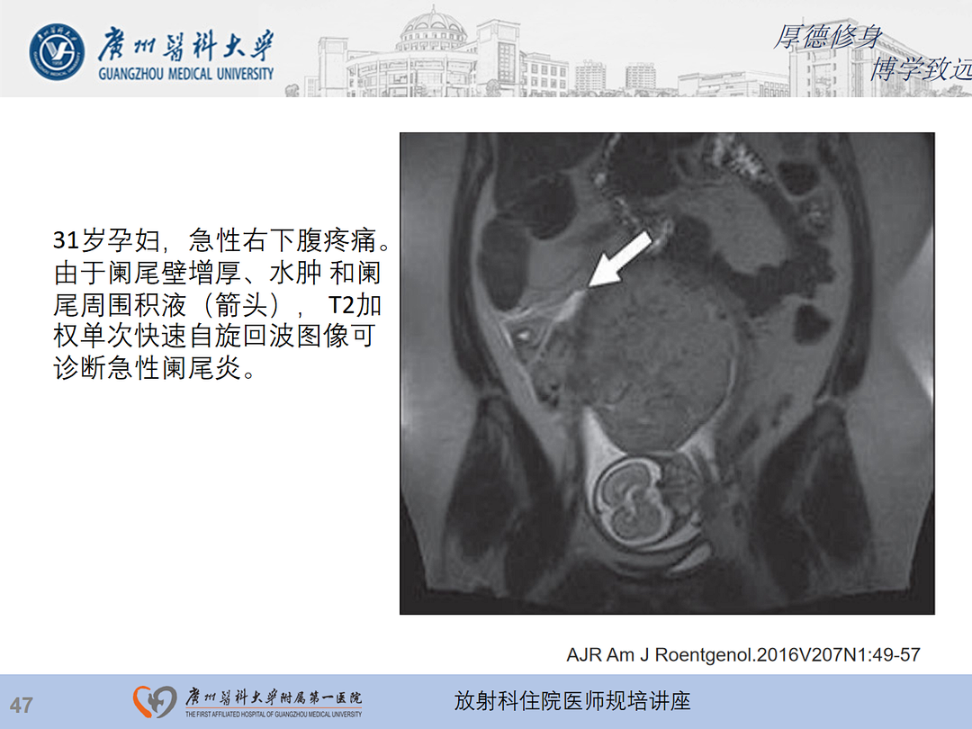 影像PPT - 【PPT】急性阑尾炎影像诊断思考和综述-48