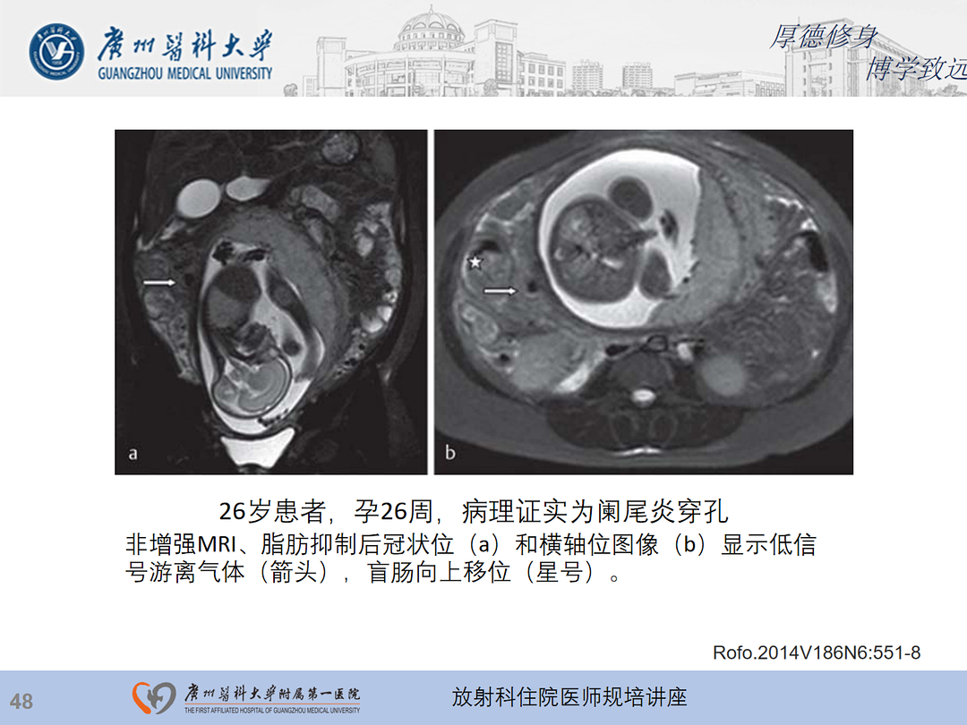 影像PPT - 【PPT】急性阑尾炎影像诊断思考和综述-49