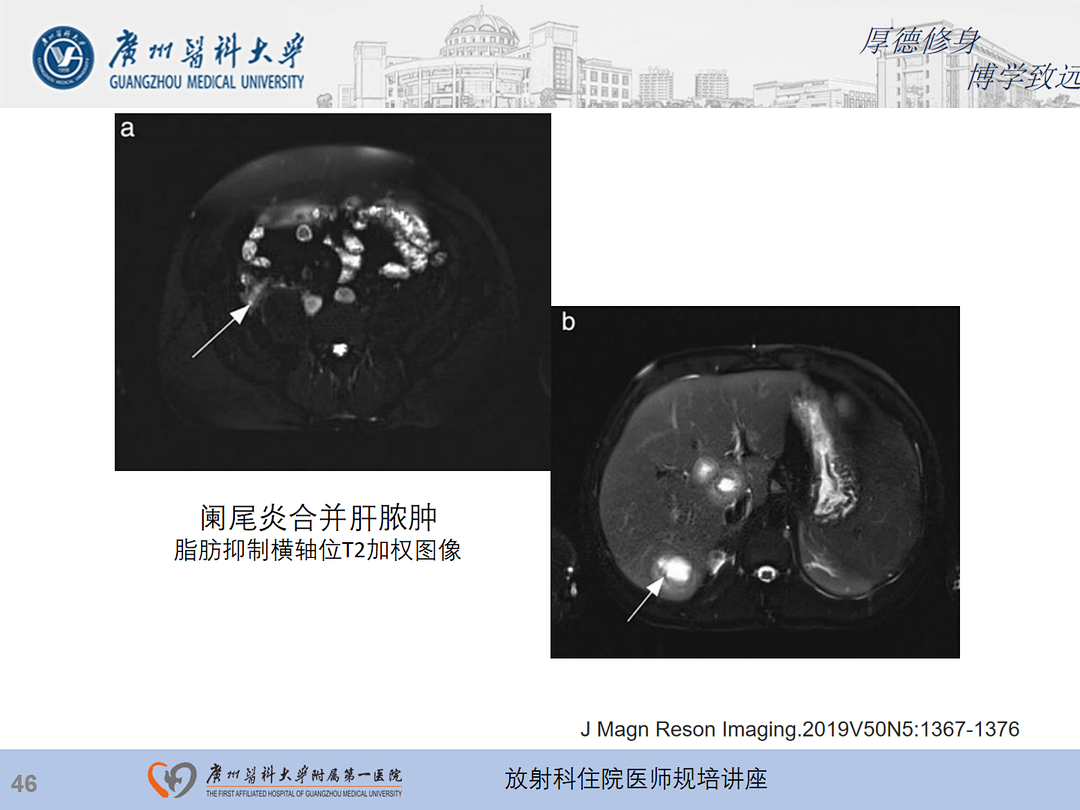 影像PPT - 【PPT】急性阑尾炎影像诊断思考和综述-47