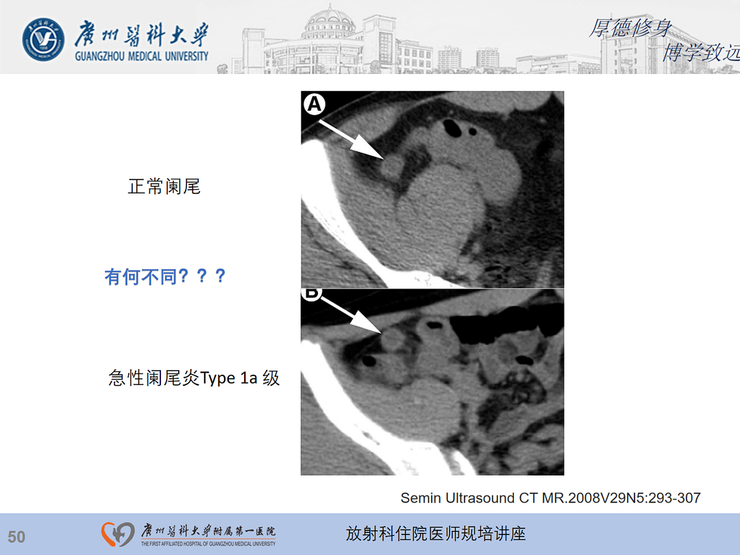 影像PPT - 【PPT】急性阑尾炎影像诊断思考和综述-51