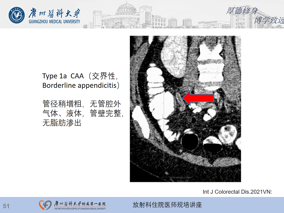 影像PPT - 【PPT】急性阑尾炎影像诊断思考和综述-52