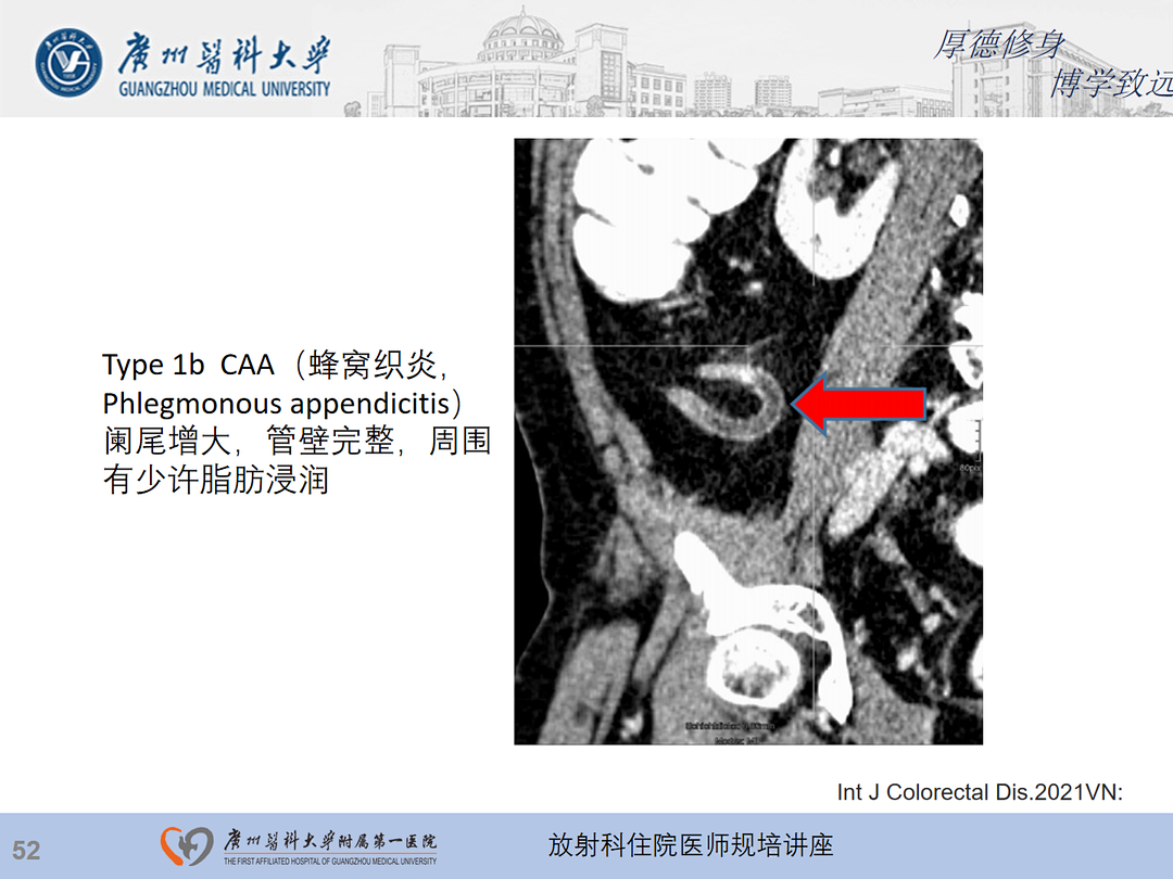影像PPT - 【PPT】急性阑尾炎影像诊断思考和综述-53