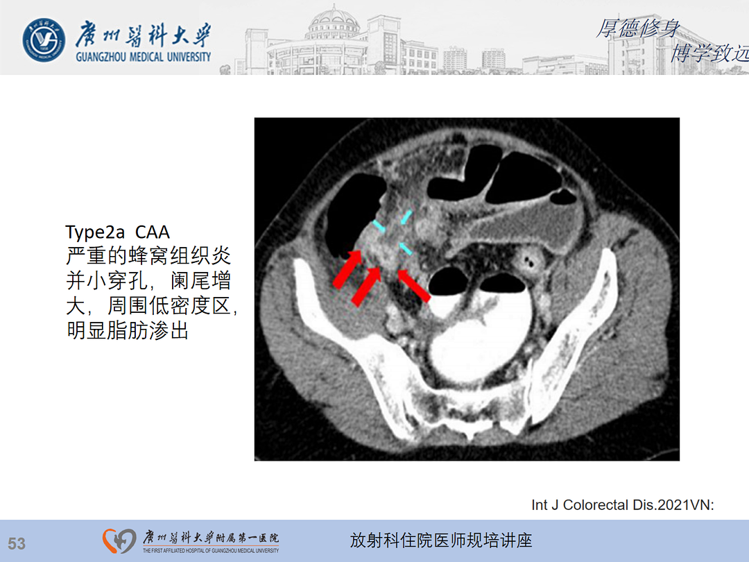 影像PPT - 【PPT】急性阑尾炎影像诊断思考和综述-54