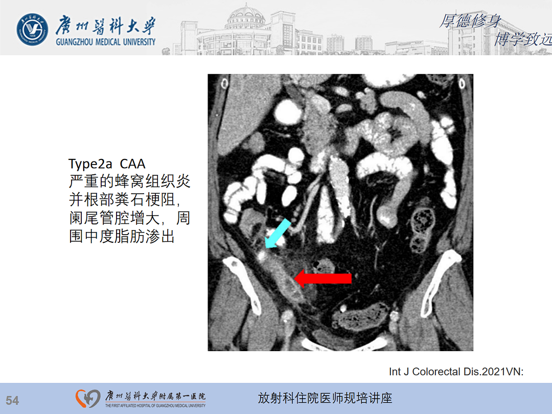 影像PPT - 【PPT】急性阑尾炎影像诊断思考和综述-55