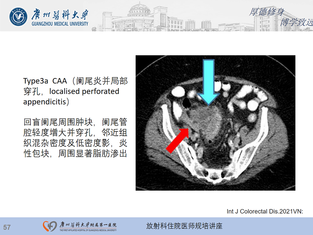 影像PPT - 【PPT】急性阑尾炎影像诊断思考和综述-58