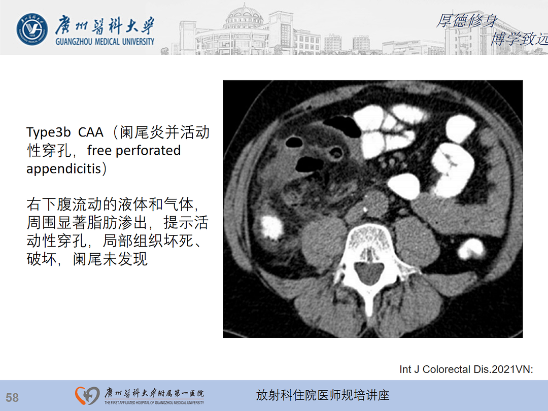 影像PPT - 【PPT】急性阑尾炎影像诊断思考和综述-59