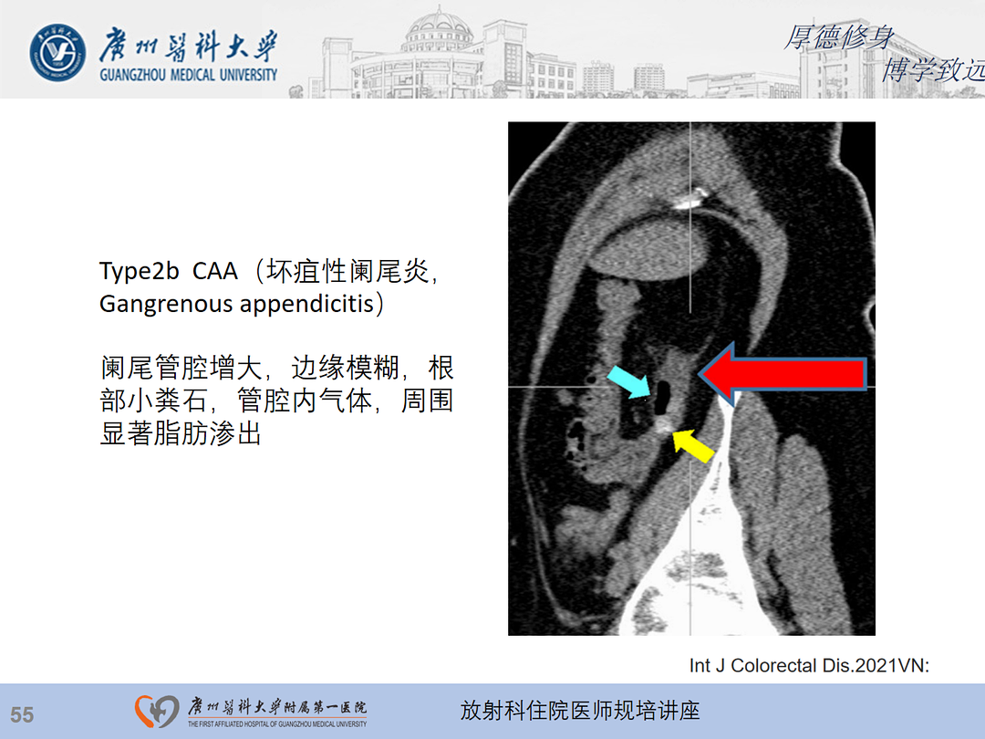 影像PPT - 【PPT】急性阑尾炎影像诊断思考和综述-56