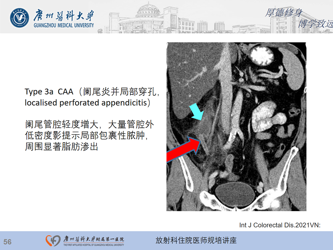 影像PPT - 【PPT】急性阑尾炎影像诊断思考和综述-57