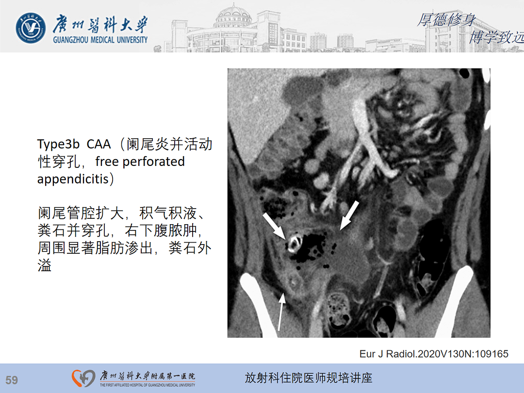 影像PPT - 【PPT】急性阑尾炎影像诊断思考和综述-60
