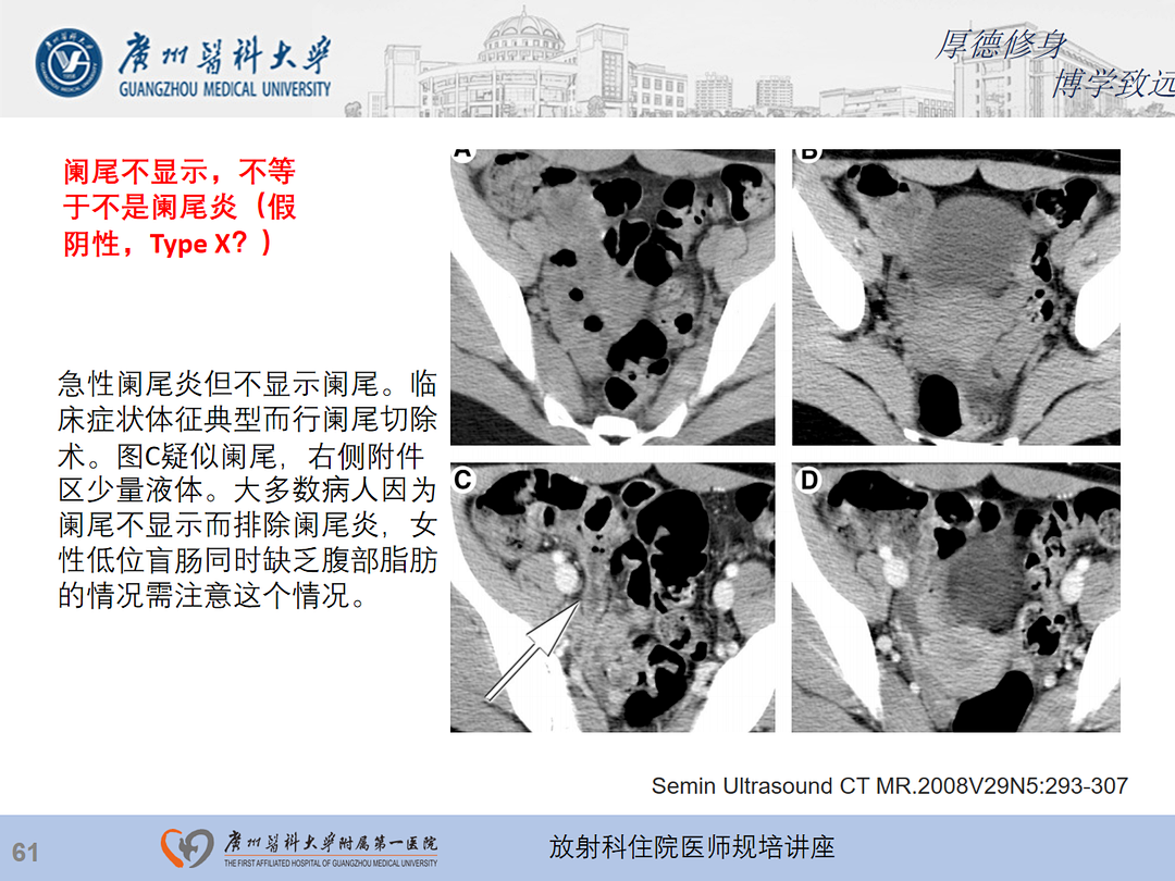 影像PPT - 【PPT】急性阑尾炎影像诊断思考和综述-62