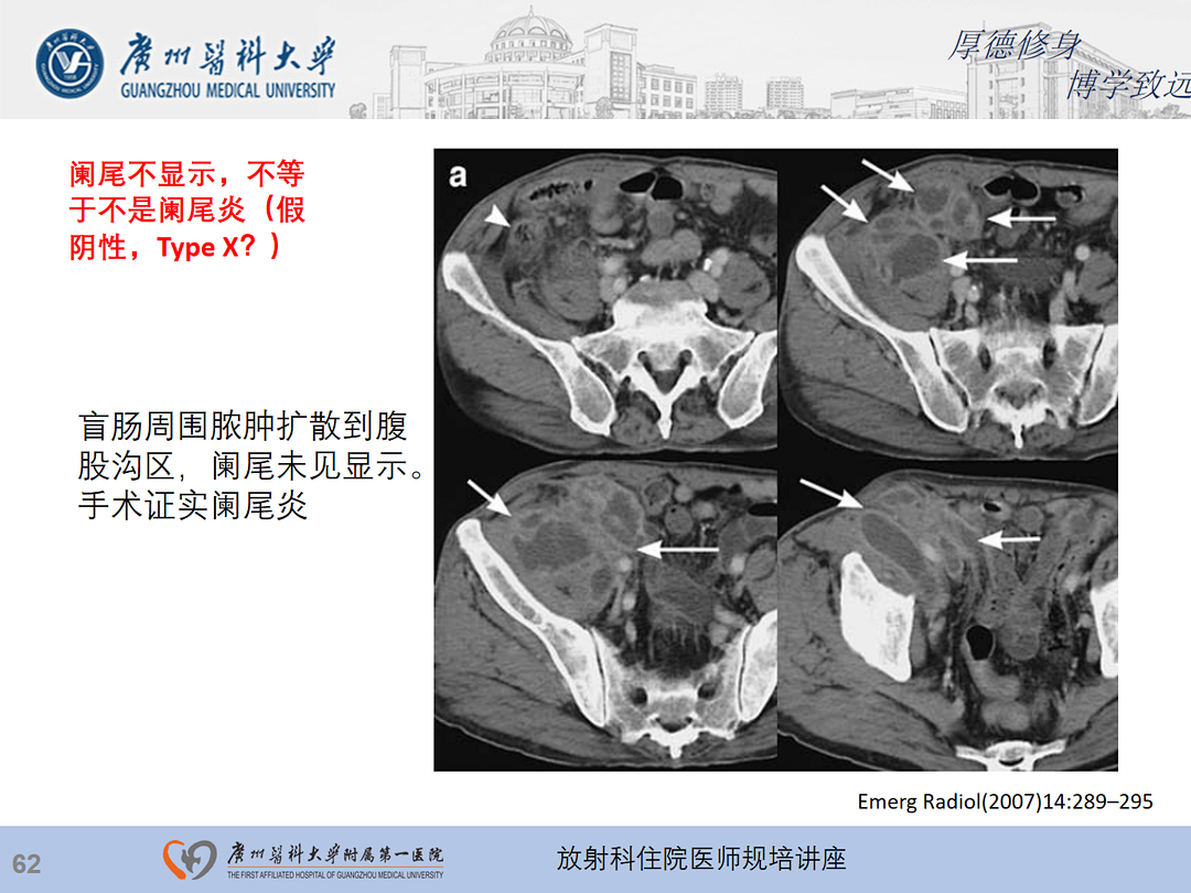 影像PPT - 【PPT】急性阑尾炎影像诊断思考和综述-63
