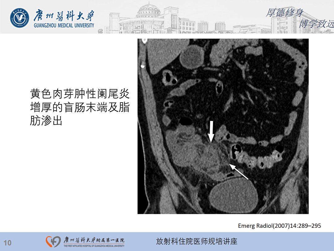 影像PPT - 【PPT】急性阑尾炎影像诊断思考和综述-74