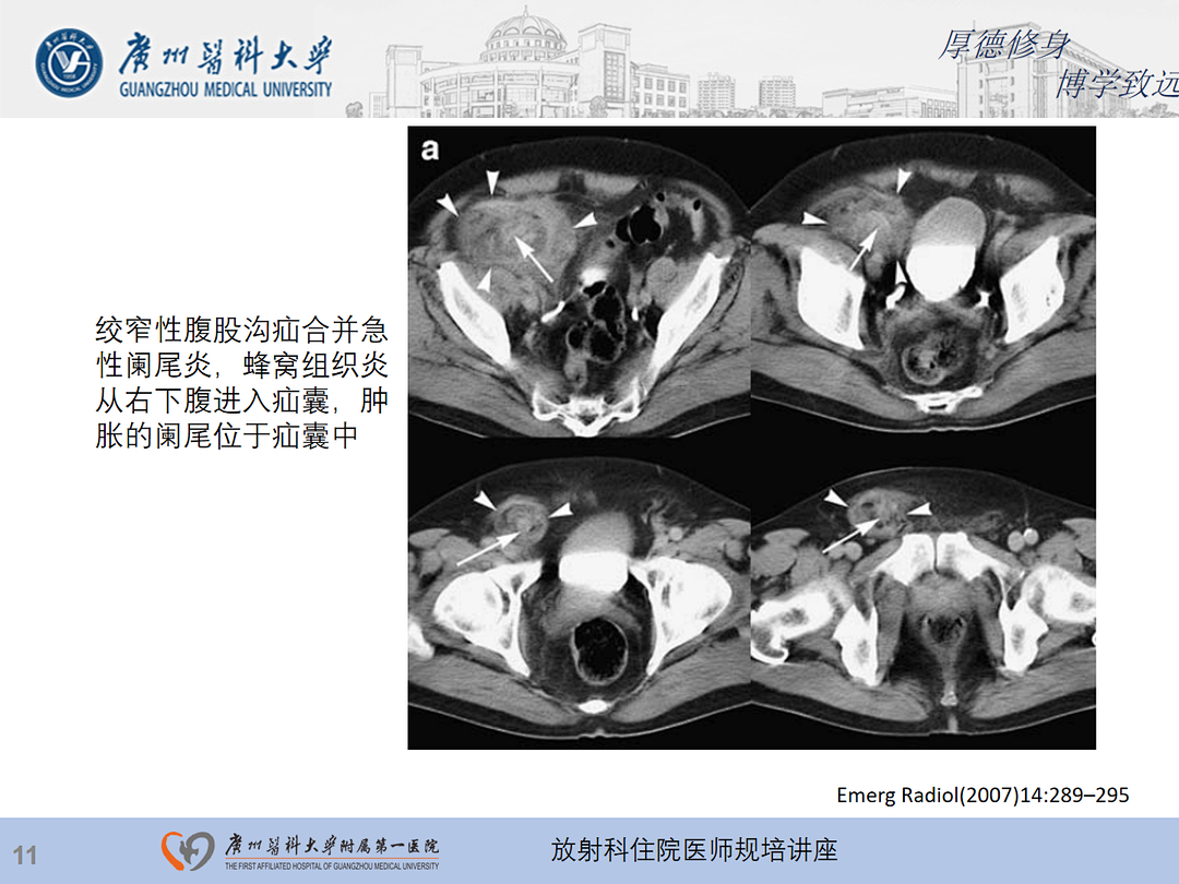 影像PPT - 【PPT】急性阑尾炎影像诊断思考和综述-75