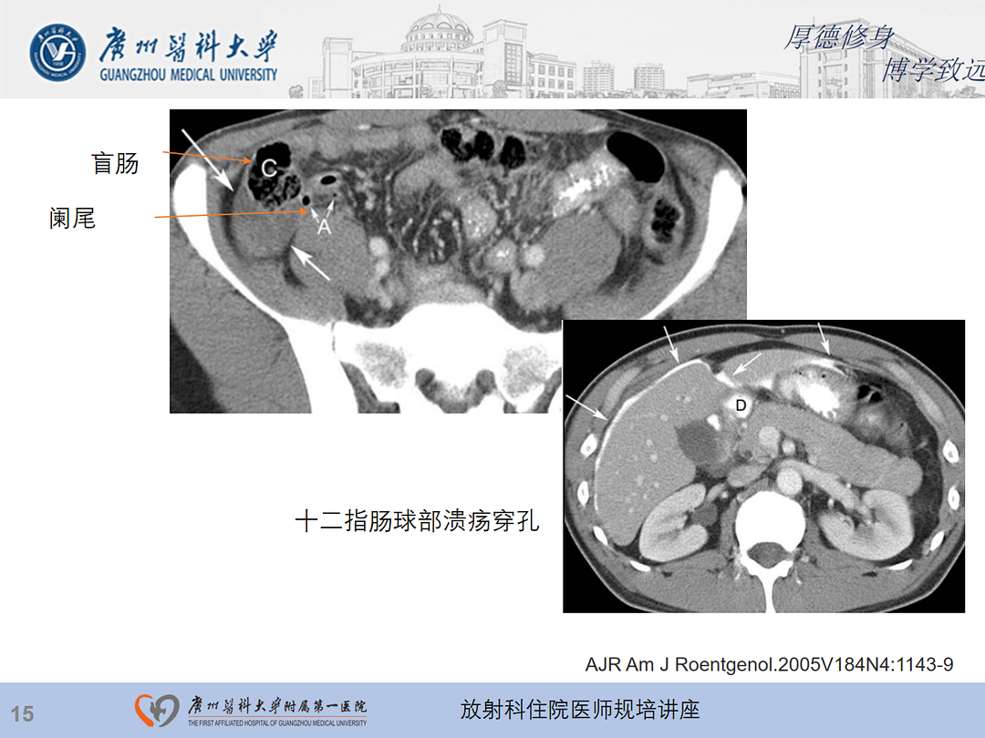 影像PPT - 【PPT】急性阑尾炎影像诊断思考和综述-79