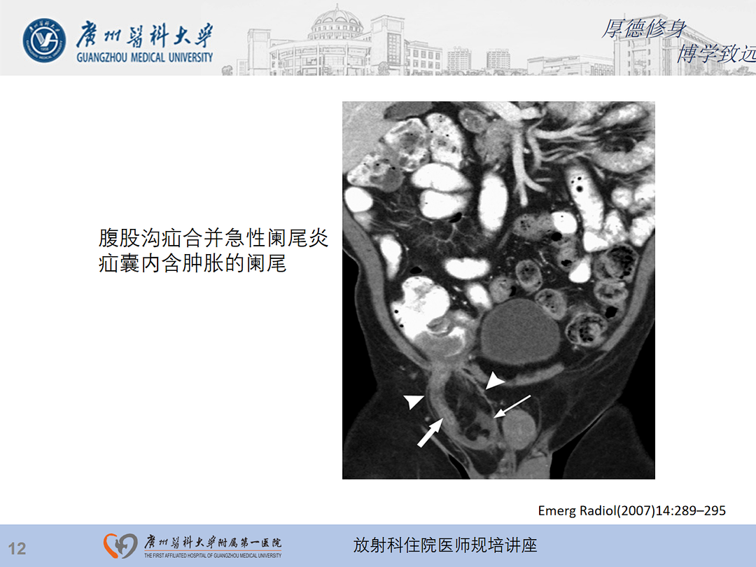影像PPT - 【PPT】急性阑尾炎影像诊断思考和综述-76