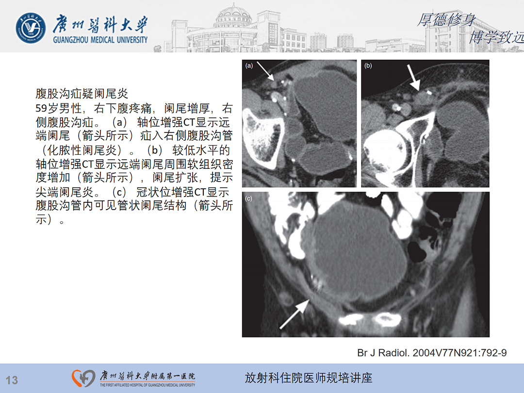 影像PPT - 【PPT】急性阑尾炎影像诊断思考和综述-77