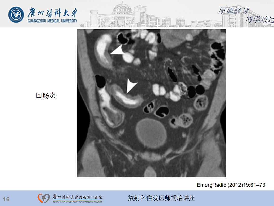 影像PPT - 【PPT】急性阑尾炎影像诊断思考和综述-80