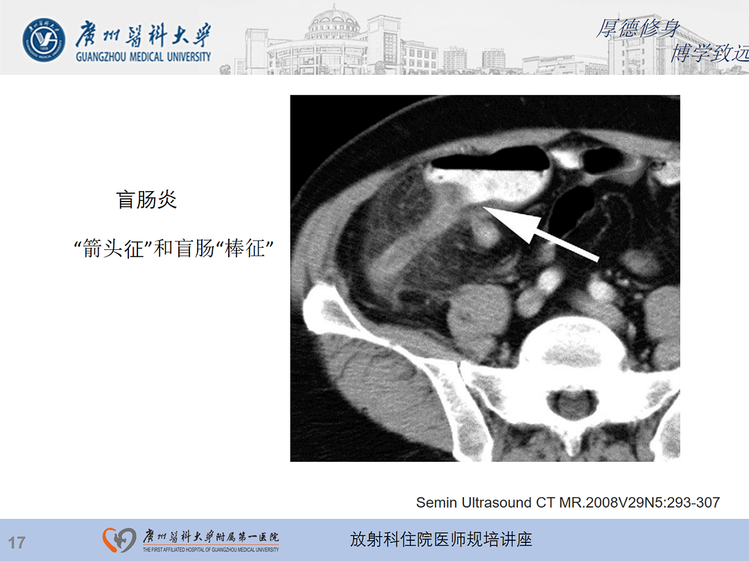 影像PPT - 【PPT】急性阑尾炎影像诊断思考和综述-81
