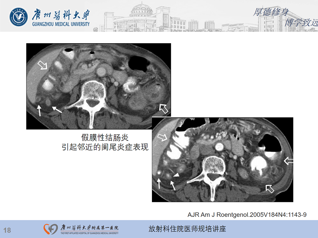 影像PPT - 【PPT】急性阑尾炎影像诊断思考和综述-82