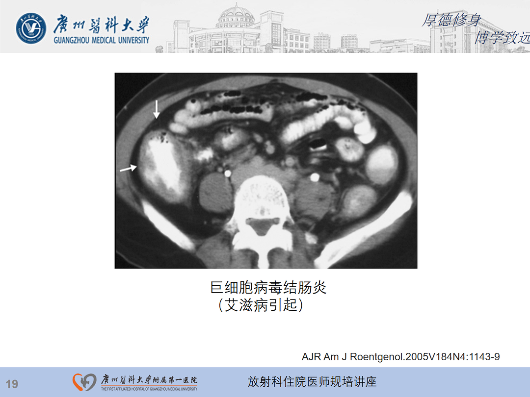 影像PPT - 【PPT】急性阑尾炎影像诊断思考和综述-83