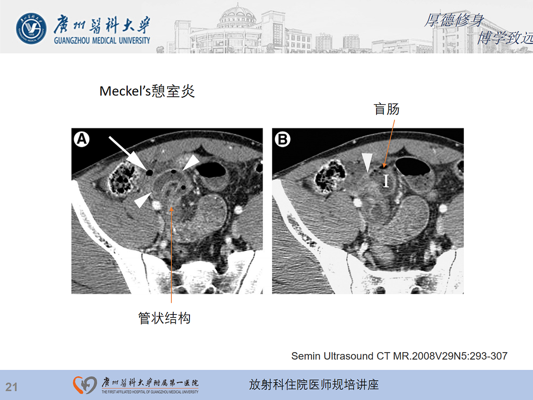 影像PPT - 【PPT】急性阑尾炎影像诊断思考和综述-85
