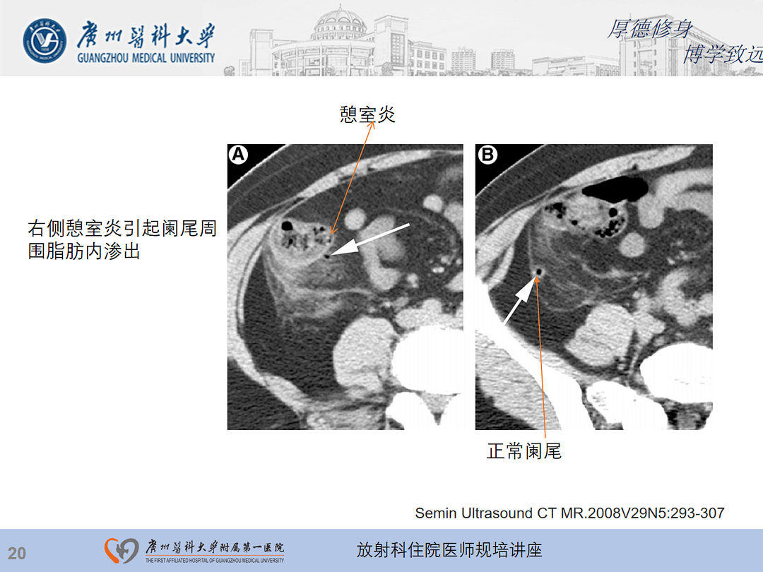 影像PPT - 【PPT】急性阑尾炎影像诊断思考和综述-84