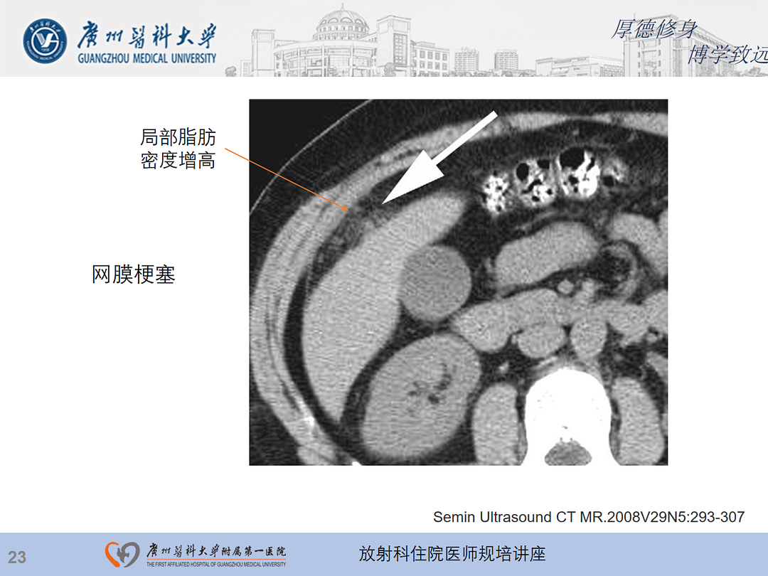 影像PPT - 【PPT】急性阑尾炎影像诊断思考和综述-87